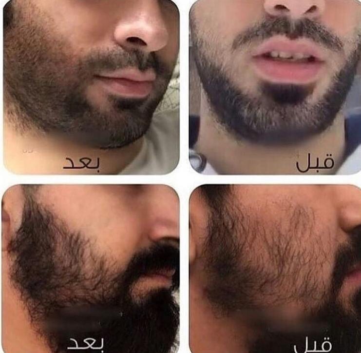 منتج الاصلي لجميع مشاكل الشعر الراس الذقن والشارب اللتي لم تصل لدرجة الصلع منتج اصلي ليسا دعايه
لا تنسَ أنك شاهدت هذا الإعلان في عنكبوت...