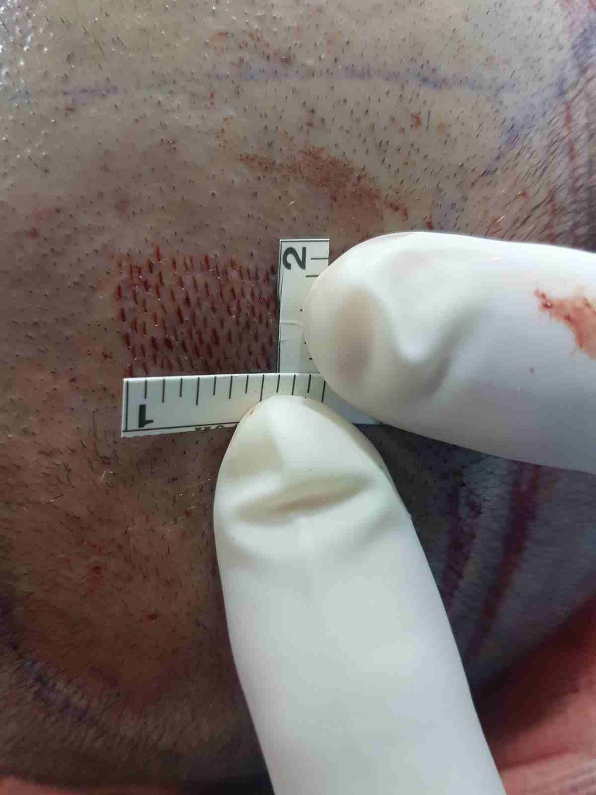 زراعة الشعر باسطنبول
لا تنسَ أنك شاهدت هذا الإعلان في عنكبوت
عملية زراعة الشعر الآن مضمونة وناجحة...