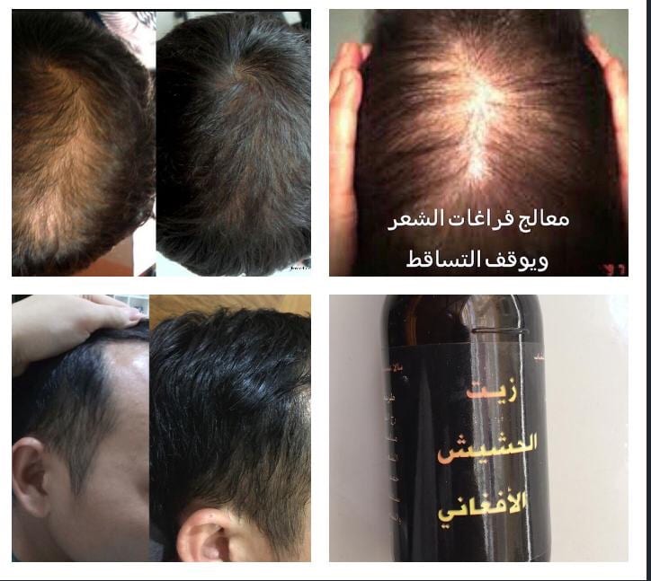 منتج الاصلي لجميع مشاكل الشعر الراس الذقن والشارب اللتي لم تصل لدرجة الصلع منتج اصلي ليسا دعايه
لا تنسَ أنك شاهدت هذا الإعلان في عنكبوت...