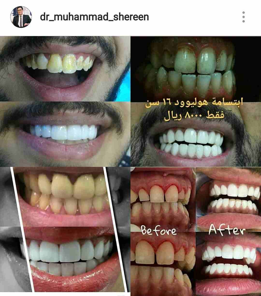 ابتسامة المشاهير فقط 7999 ريال
لا تنسَ أنك شاهدت هذا الإعلان في عنكبوت
الحشوات و التنظيف مجانا و...