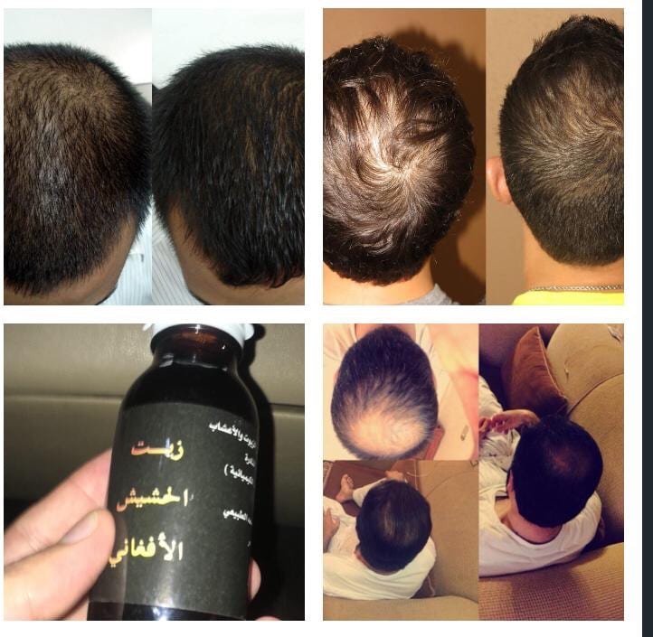 منتج الاصلي لجميع مشاكل الشعر الراس الذقن والشارب اللتي لم تصل لدرجة الصلع منتج اصلي ليسا دعايه
لا تنسَ أنك شاهدت هذا الإعلان في عنكبوت...