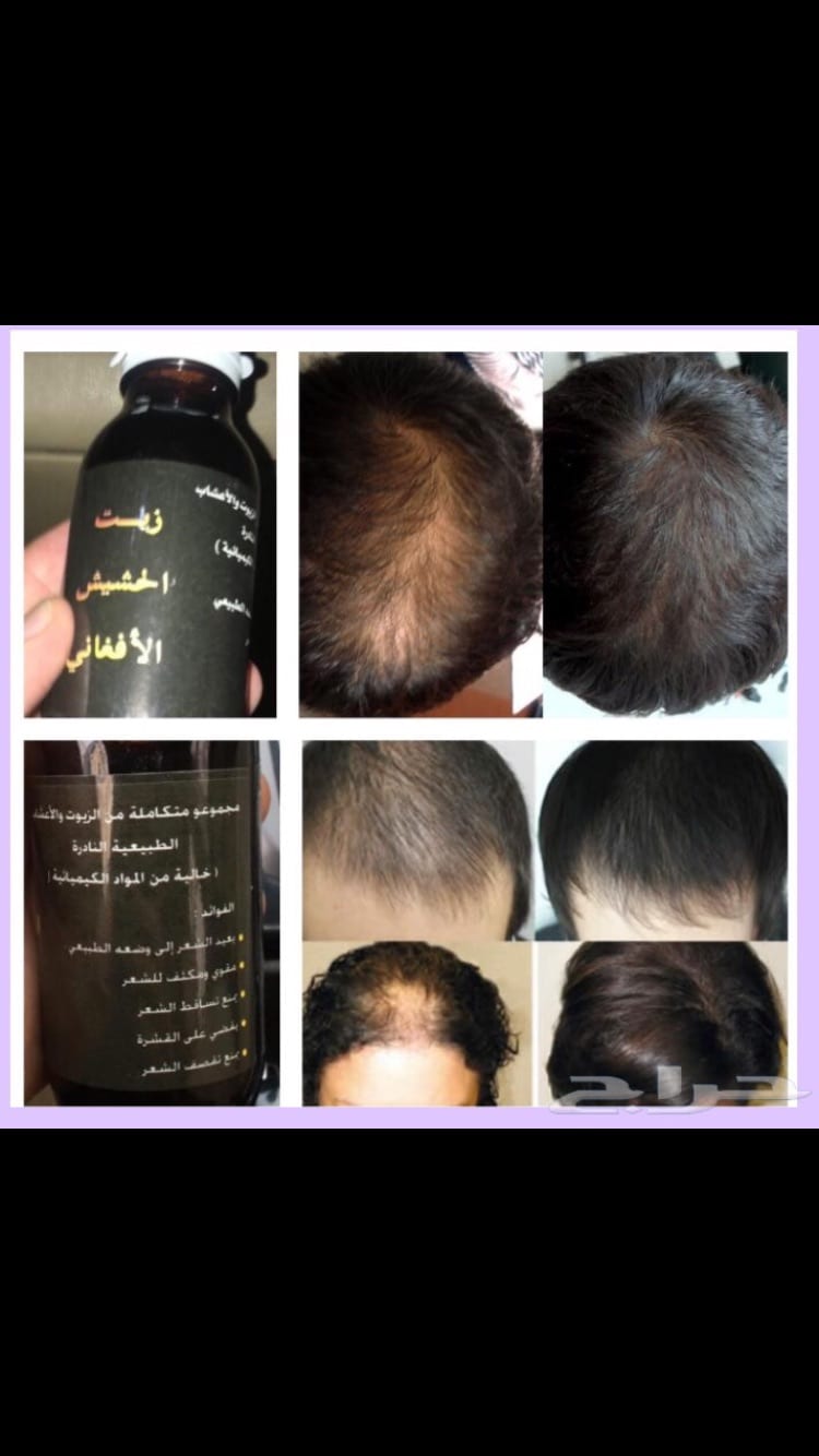 منتج الاصلي لجميع مشاكل الشعر الراس الذقن والشارب اللتي لم تصل لدرجة الصلع منتج اصلي ليسا دعايه
لا تنسَ أنك شاهدت هذا الإعلان في عنكبوت...