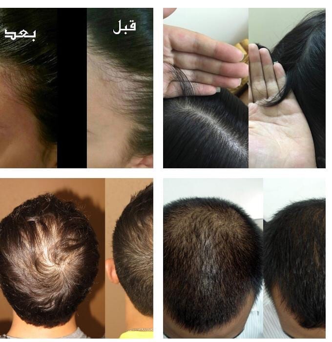 منتج الاصلي لجميع مشاكل الشعر الراس الذقن والشارب اللتي لم تصل لدرجة الصلع منتج اصلي ليسا دعايه
لا تنسَ أنك شاهدت هذا الإعلان في عنكبوت...