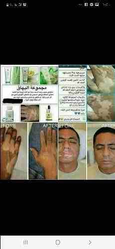 مجموعة علاج البهاق 😍😍 من شركة فورايفر الامريكيه 👌
#علاج_مضمون_بتجارب_مستخدمي 👇👇
البهاق أحد الأمراض الجلدية المنتشرة في العالم 🌍🌍 ويعرف تحديداً بزوال اللون الطبيعي للجلد على شكل بقع بيضاء واضحة...